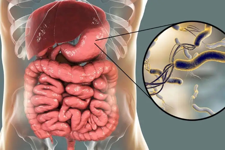 Helicobacter pylori : 5 traitements naturels efficaces