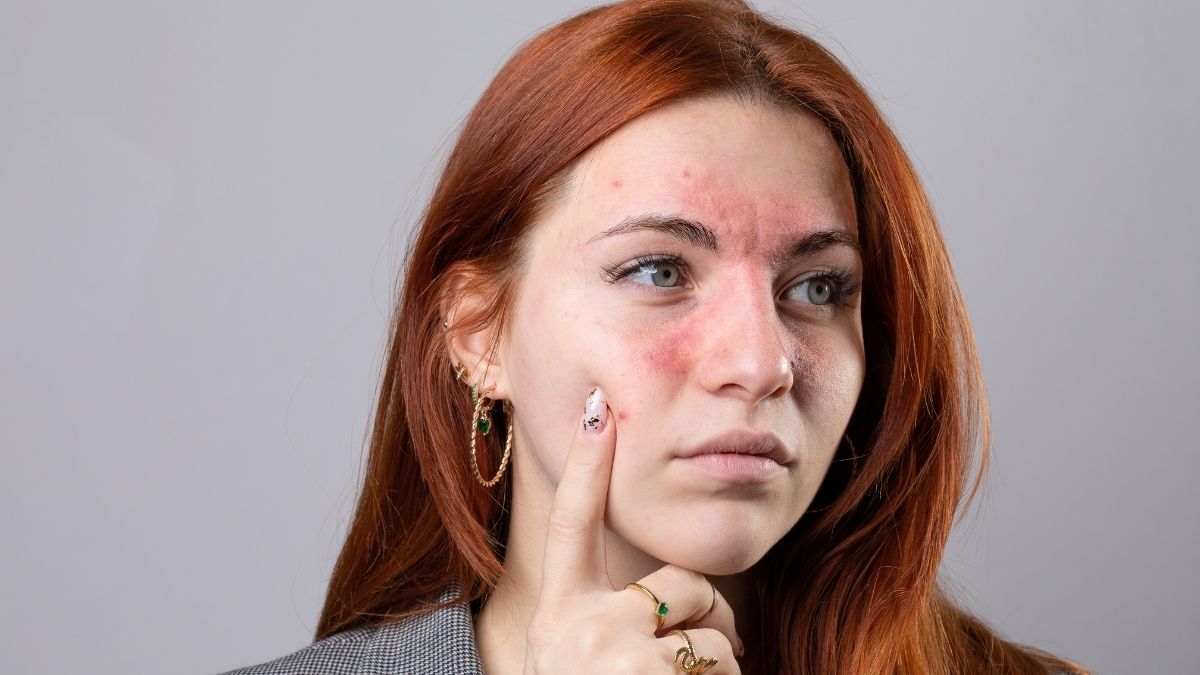 Problème de peau, le lien avec les probiotiques